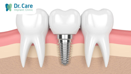 Rối loạn khớp dẫn đến mất răng có trồng Implant được không?