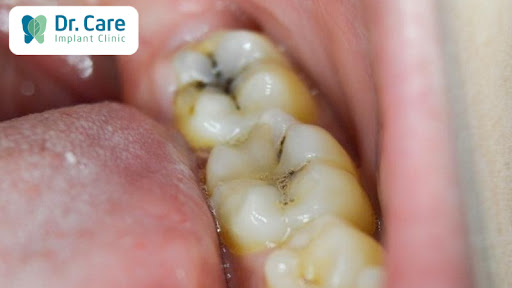 5 nguyên nhân gây viêm tủy răng số 7