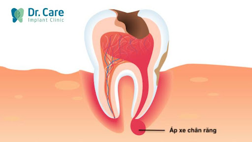 Các triệu chứng viêm tủy răng số 8 