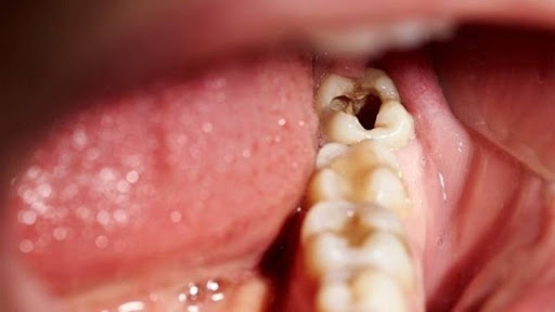 Viêm tủy răng số 8 có nguy hiểm không?