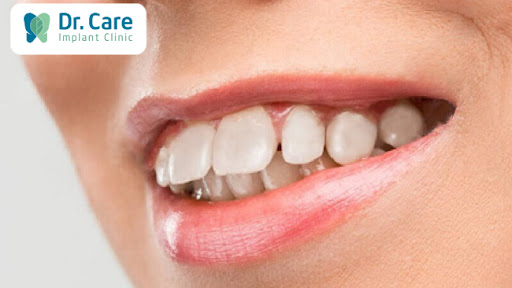 Răng sứ Vita phù hợp với những trường hợp nào?
