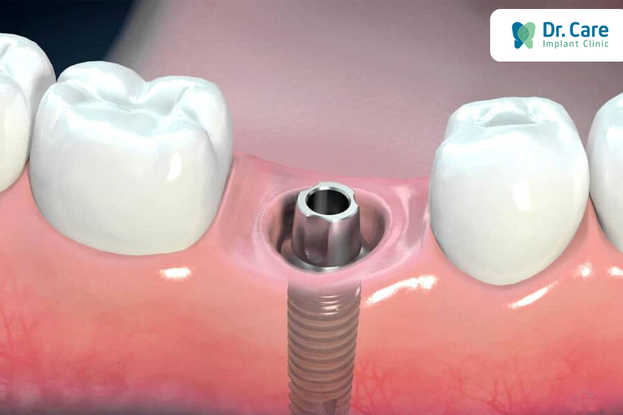 7 yếu tố ảnh hưởng đến độ đau sau khi trồng răng Implant