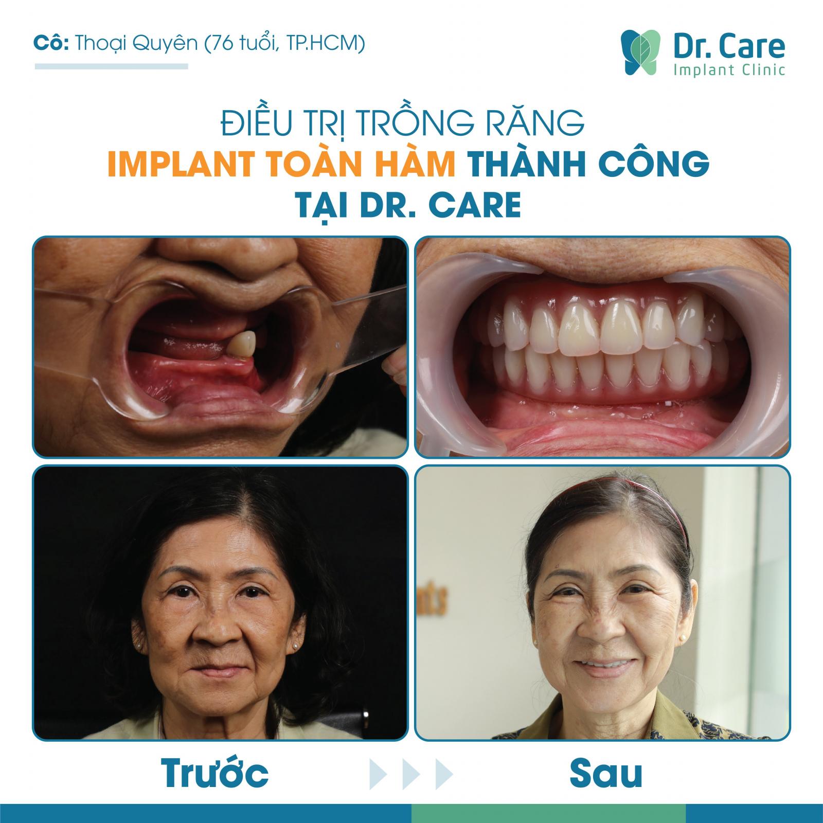 Trường hợp được chỉ định trồng răng Implant toàn hàm All On - 4