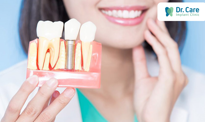 Những lưu ý khi trồng răng Implant để hạn chế đau nhức