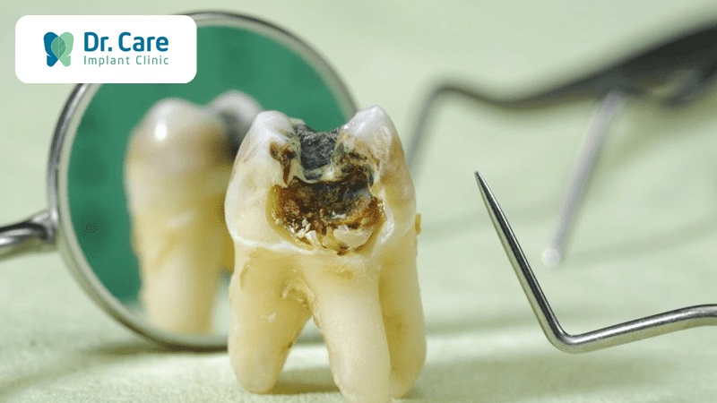 Sâu răng có thể tự chữa tại nhà không?