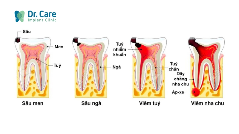 Các giai đoạn phát triển của sâu răng 
