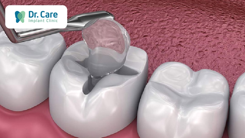 Cách điều trị sâu răng hiệu quả tại Nha khoa