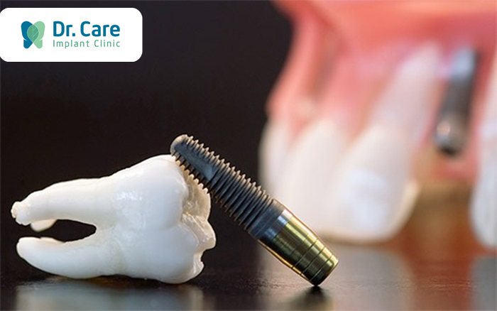Chống chỉ định khi trồng răng Implant toàn hàm All On 6
