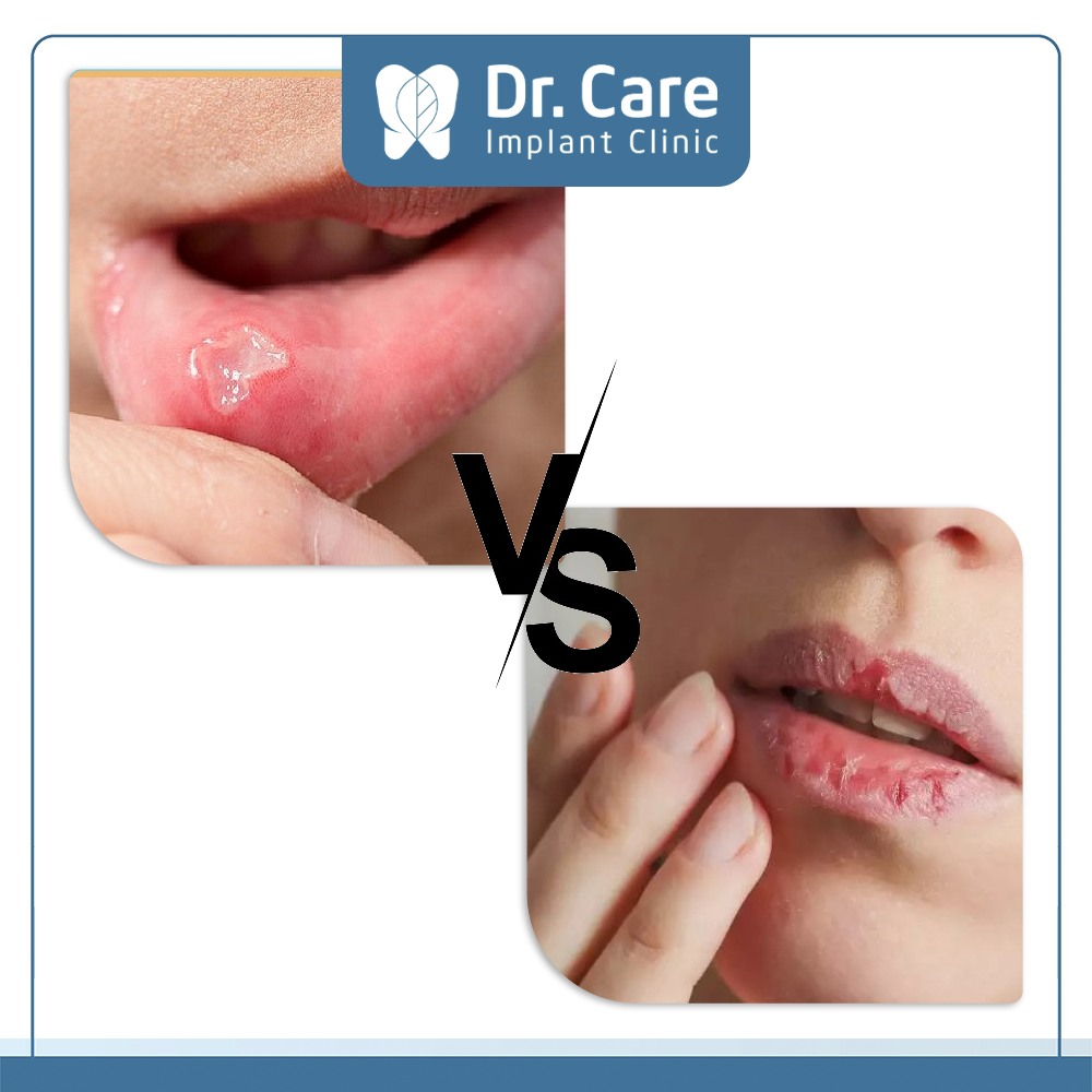 Phân biệt viêm loét miệng thông thường với bệnh viêm nhiễm ở miệng khác