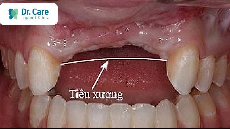 Teo nướu răng là gì? 