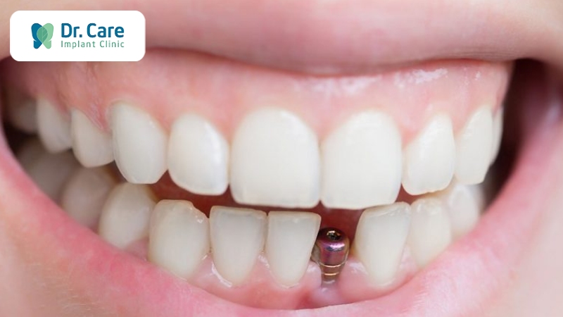 Cấy ghép răng Implant thay thế răng đã mất do cắn móng tay