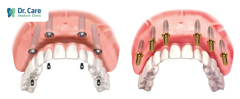 Trồng răng Implant toàn hàm loại nào tốt và tiết kiệm nhất?
