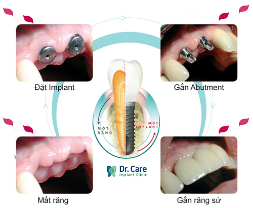 Quy trình trồng răng Implant diễn ra thế nào?