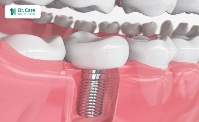 Vì sao nên trồng lại răng số 7 bằng phương pháp Implant?