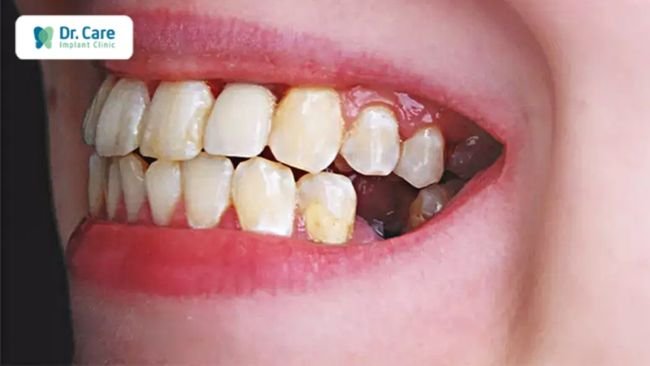 Mất răng số 7 gây ra nhiều bệnh lý răng miệng