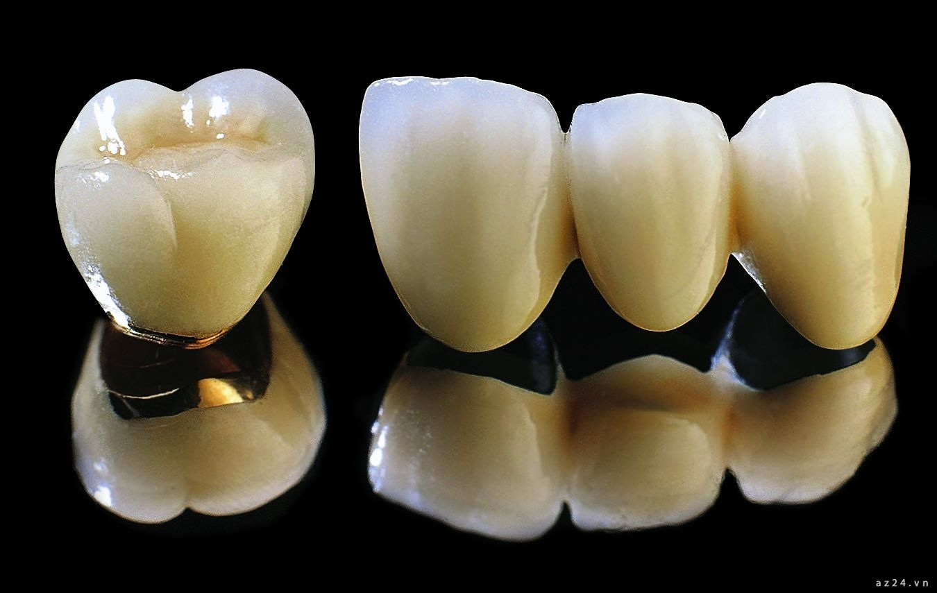 3 Nhược điểm của răng sứ kim loại