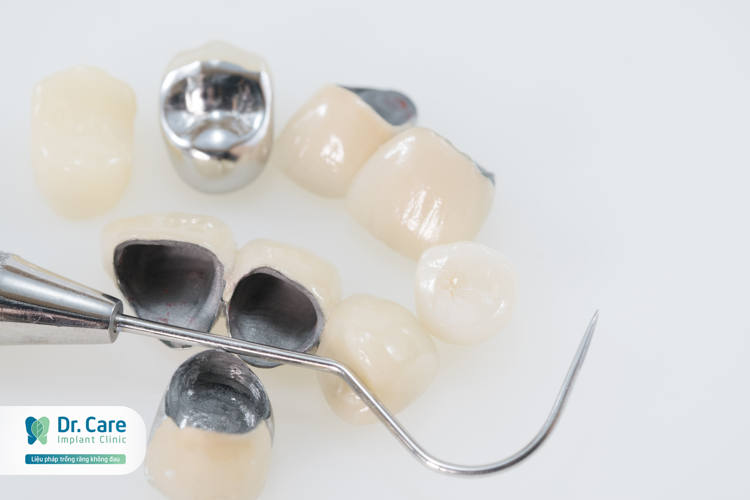 So sánh giá của răng sứ kim loại với các loại răng sứ khác