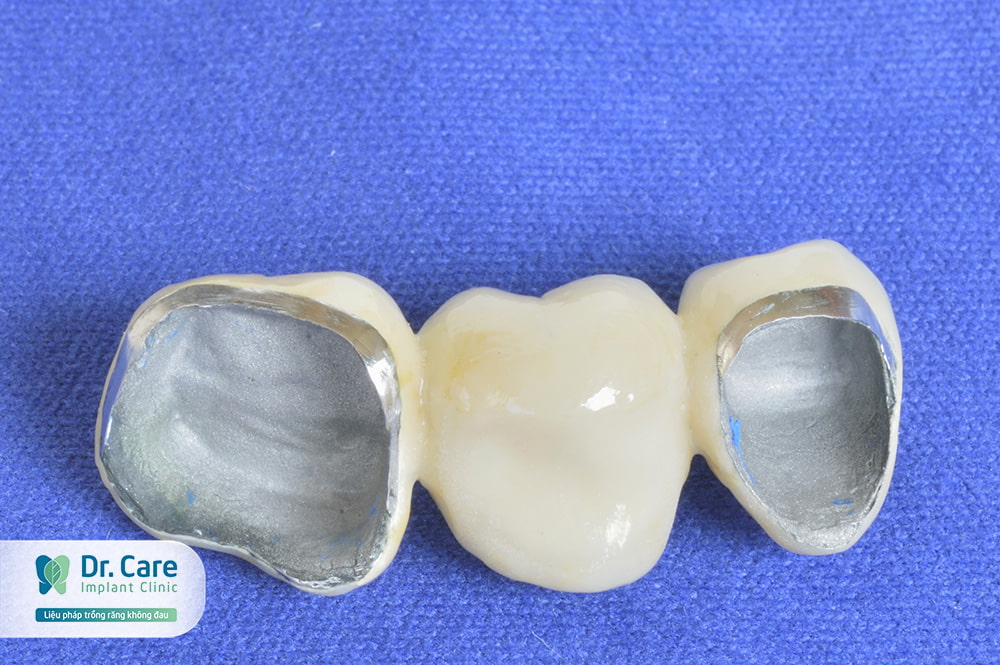 Nên chọn loại răng sứ kim loại nào tốt nhất?