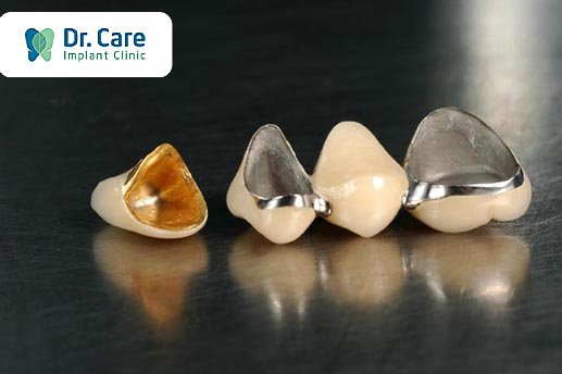 3 loại răng sứ kim loại phổ biến hiện nay