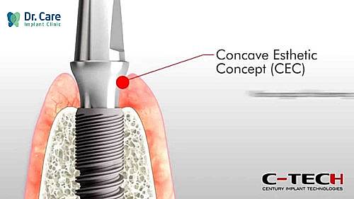 4 Ưu điểm của trụ Implant C-Tech 