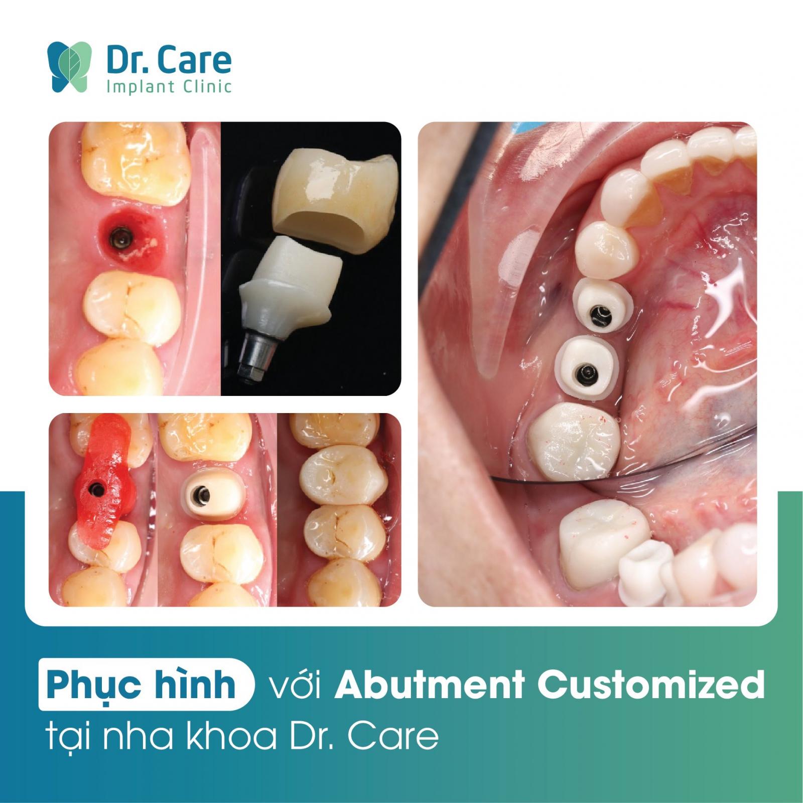 Khách hàng trồng răng Implant thành công tại Dr. Care