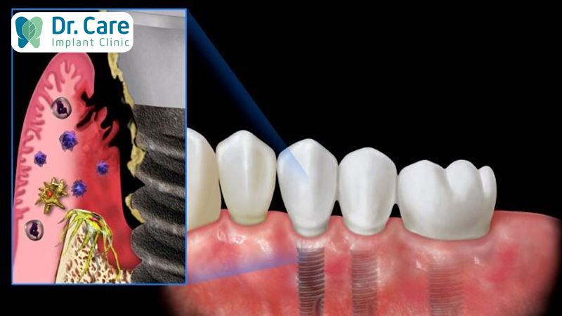 Tìm hiểu về nhiễm trùng sau khi trồng răng Implant