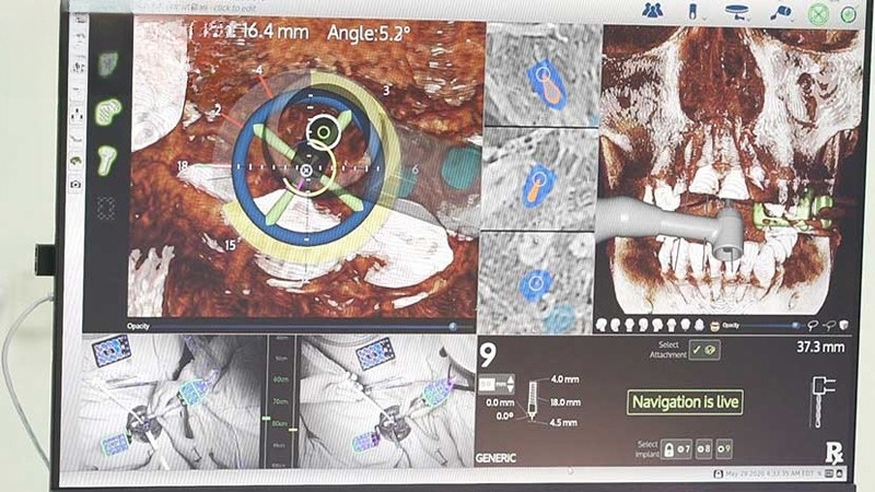 Ứng dụng của công nghệ robot định vị trong hướng dẫn phẫu thuật