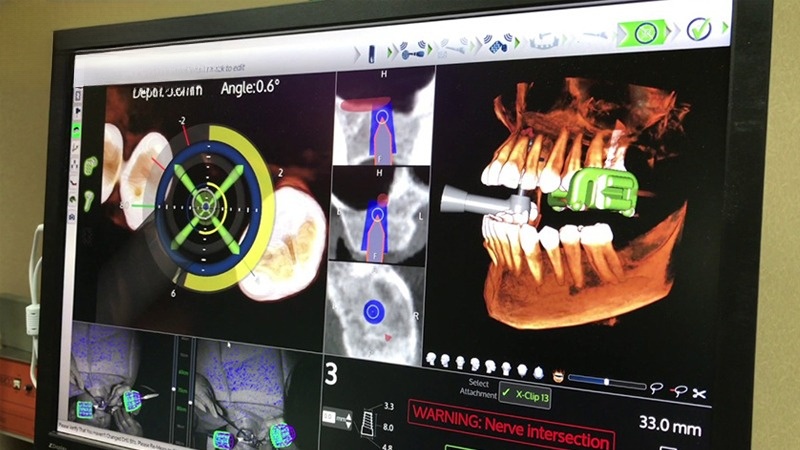Ưu điểm của công nghệ cấy ghép Implant bằng robot định vị X-Guide là độ chính xác cao