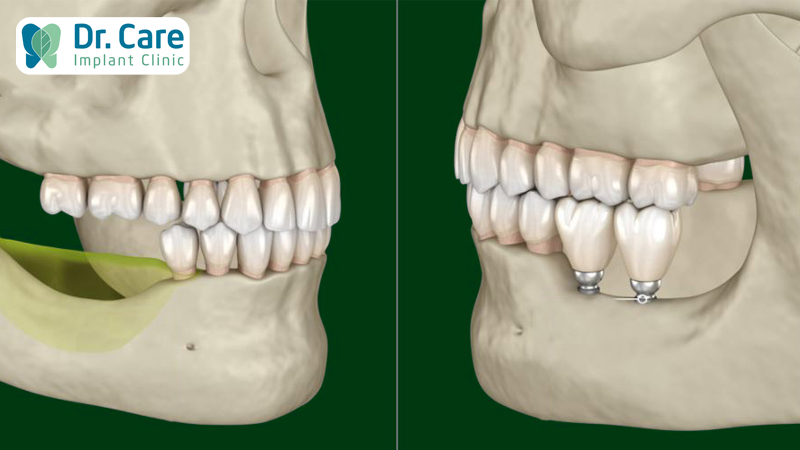 Bị tiêu xương hàm trồng răng Implant có phức tạp không?
