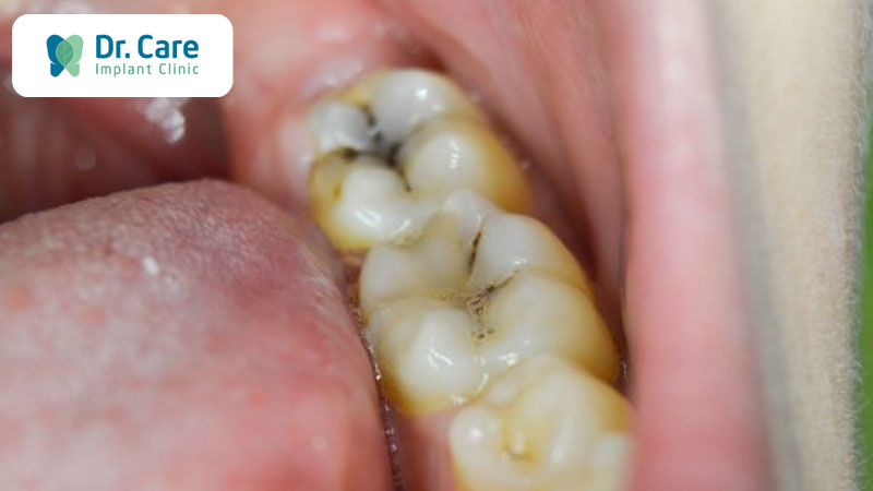 Sâu răng - bệnh lý răng miệng phổ biến nhất