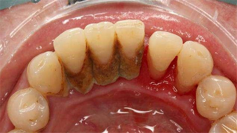 Vệ sinh răng miệng chưa đúng cách gây nên bệnh lý răng miệng