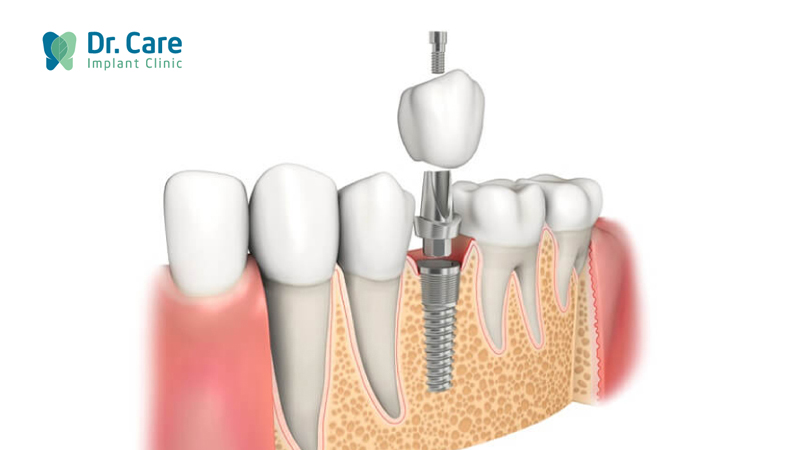 Mất răng sau khi bọc sứ bị viêm tủy có nên trồng Implant hay không?