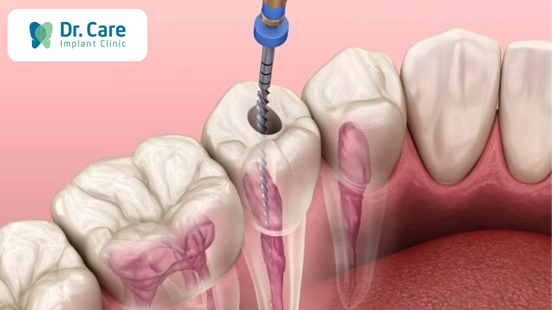 Quy trình điều trị răng bọc sứ bị viêm tủy hiệu quả