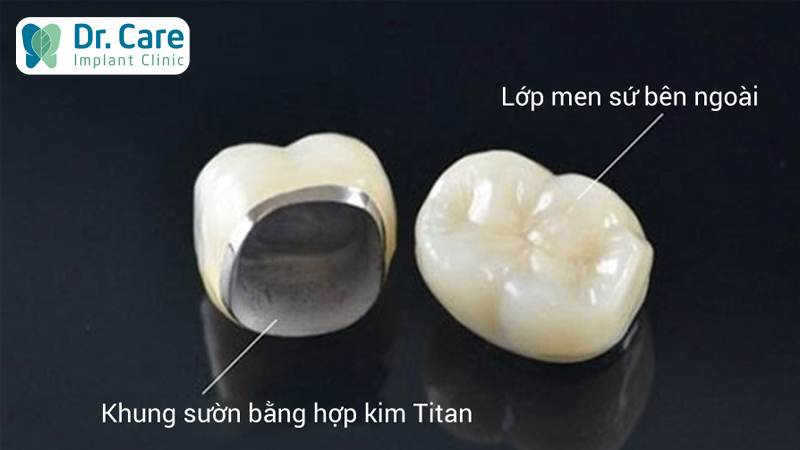 Răng sứ là gì? Cấu tạo của 1 chiếc răng sứ gồm mấy phần