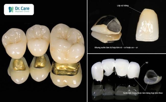 Răng sứ kim loại Titan