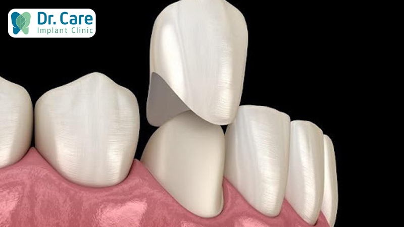 Răng sứ là gì? Đối tượng nào nên sử dụng răng sứ