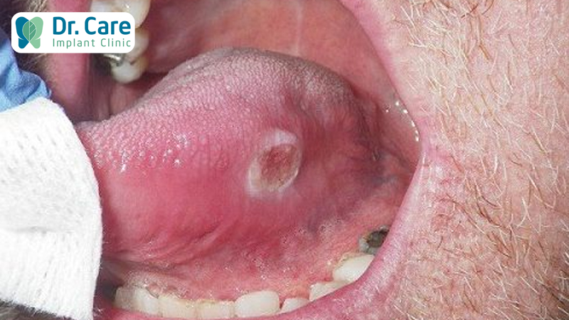 Nhiệt miệng và ung thư lưỡi có liên quan đến nhau không?