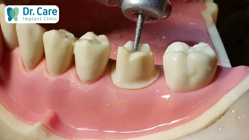 Cách xử lý khi răng sứ bị hở chân răng 