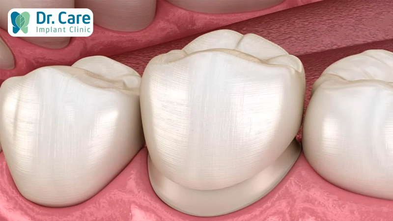 Ngăn ngừa tình trạng hở răng sứ bằng cách nào?