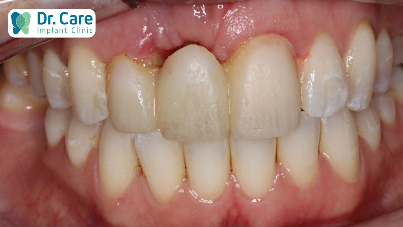 Răng sứ bị hở chân răng có nguy hiểm không?
