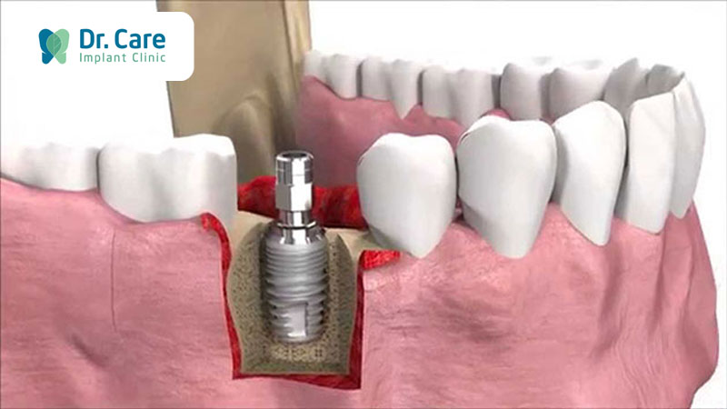 Trồng răng Implant là gì? Đối tượng nào nên trồng răng Implant?