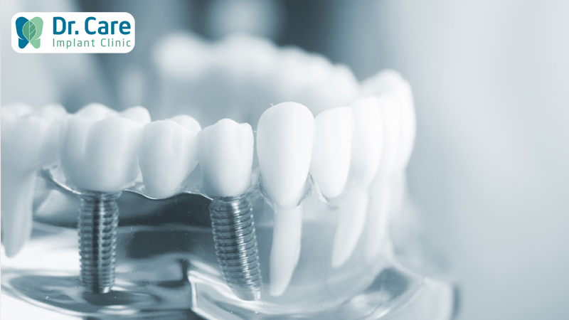 Trồng răng Implant sử dụng răng sứ Zirconia có được không?