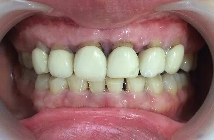 Gây viêm nhiễm, hư hại răng thật, mất răng vĩnh viễn