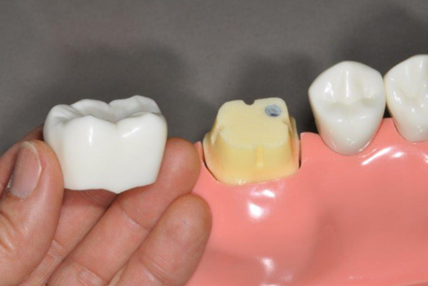 Răng sứ phục hình chế tác không chuẩn tỷ lệ
