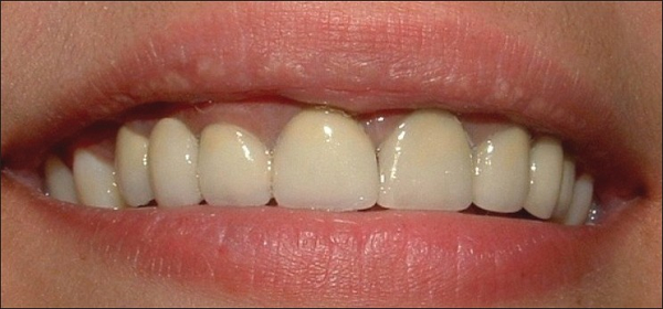 Sau khi bọc răng sứ viền nướu có màu tái nhẹ