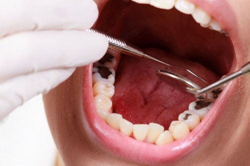 Điều trị đau nhức do sâu răng gây ra