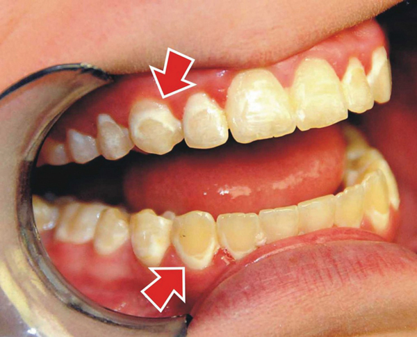 Do bệnh về răng miệng (sâu răng, viêm nha chu,...)