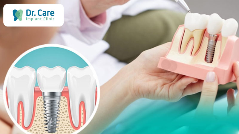Trồng răng Implant có đau không?