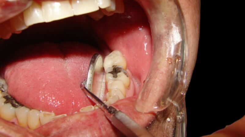 Đau nhức xuất hiện vài tháng hoặc vài năm tại vùng răng chữa tủy 