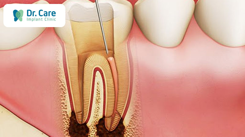 Điều trị tủy răng là gì? Tại sao phải điều trị tủy răng?